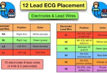 leads ecg placement