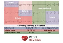 leads on ecg
