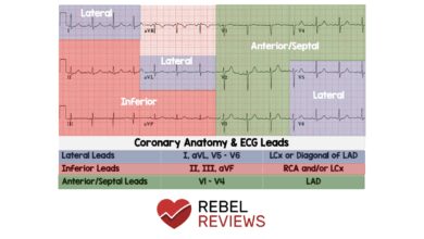 leads on ecg